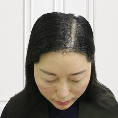 发缝变宽人很显老，做个稀少加密就可以恢复