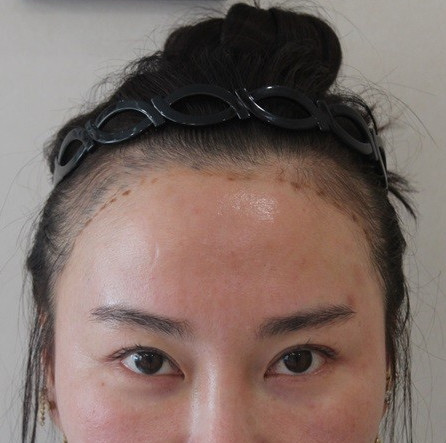 发际线种植术后一年效果分享，终于不再是大脑门儿了