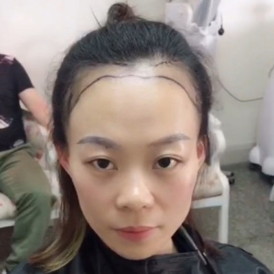 做个发际线自信扎丸子头，术后案例对比图片分享