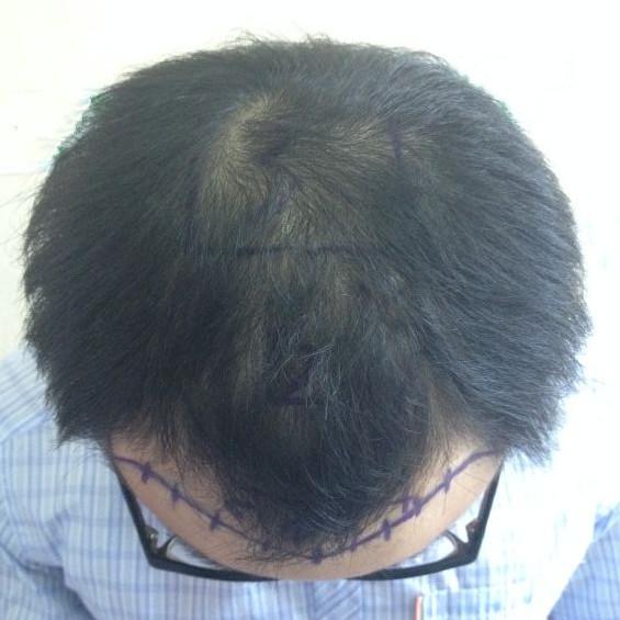 头顶整体加密种植3200个单位，术后7个月效果对比