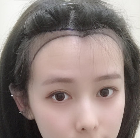发际线种植已经有了明显的效果，感觉还不错