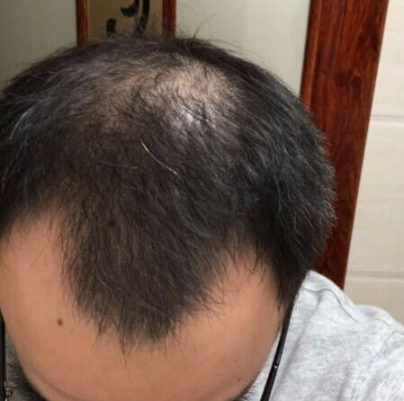 头顶加密 发际线种植5个月的成效，效果杠杠的