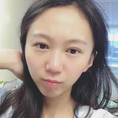 额头太大做个发际线就变美，术后案例分享