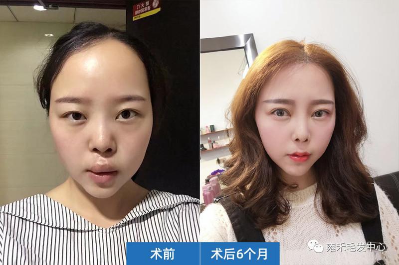 整形医院植发失败，第二次雍禾植发1610毛囊单位