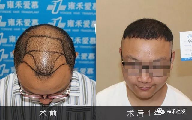 丈夫贷款植发3700单位完美的父爱形象