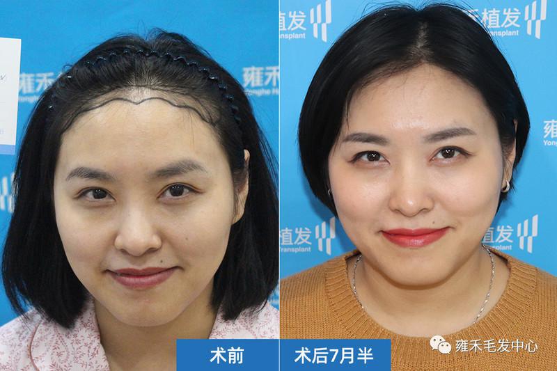 天生发际高，生完小孩脱发，植发1630单位重新美起！