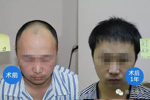 上海雍禾老案例。7年前在上海雍禾做的植发。
