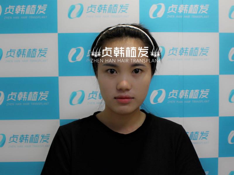 午休植个发，贞韩导医美眉种发际线，变美还不耽误工作