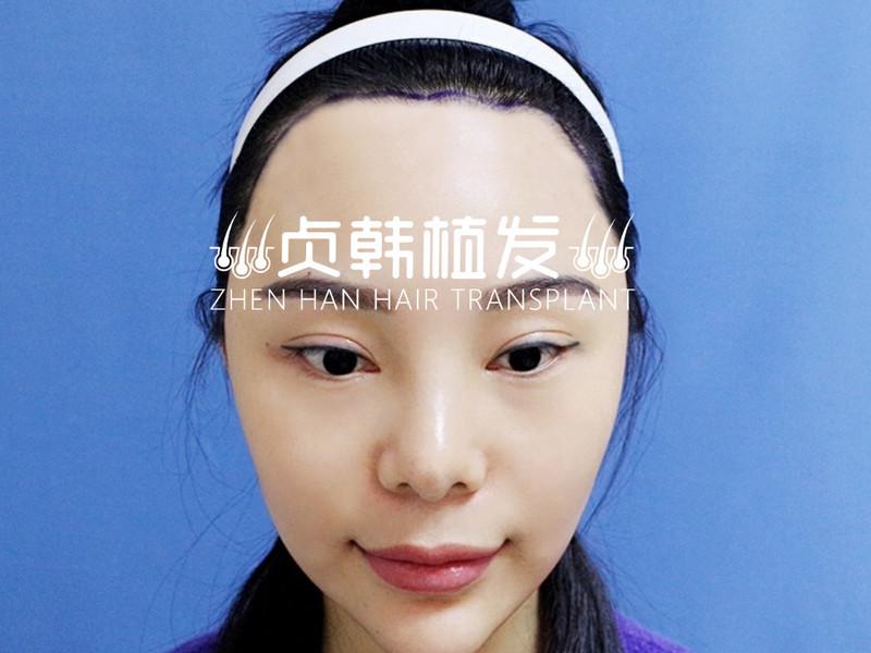 经纪人植发塑美丨女生发际线怎么才能种得好看？