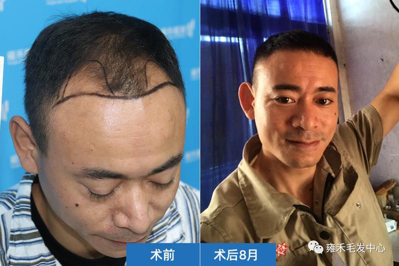 赶紧植发然后树立好形象这样就容易找女友