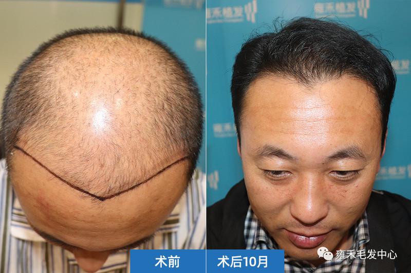 北京雍禾用FUE为张先生种植3123单位晚上植发