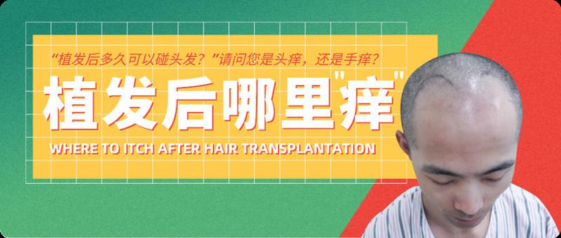 “植发后多久可以碰头发？”请问您是头痒，还是手痒？