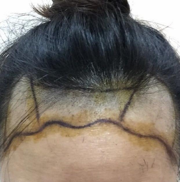 终于是种植了我喜欢的发际线，看看效果如何吧