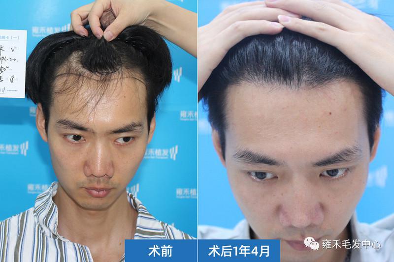 自己的发际后退属毛囊坏死，唯一的办法是植发种头发