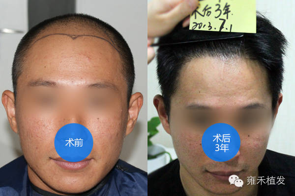 10年前的老案例你第一次见？植发2650单位