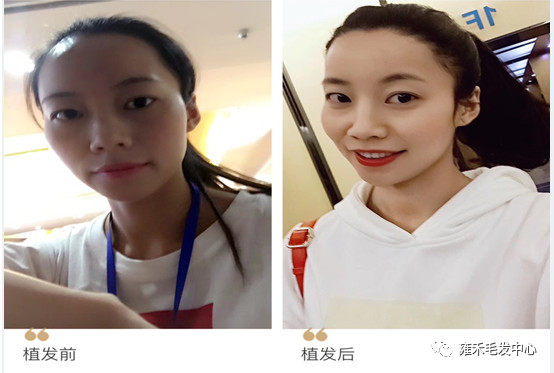 广州雍禾的尹护士发际线植发后效果美美哒