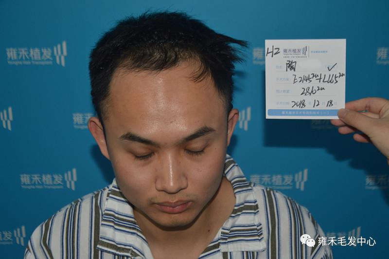 90后天生发际高杭州雍禾植发满足他明星发际线的愿望