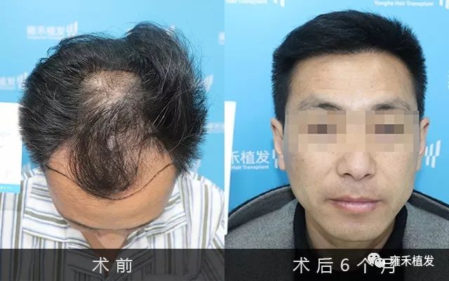 贵阳雍禾采用FUE为蒋老师植发3000单位越来越帅气