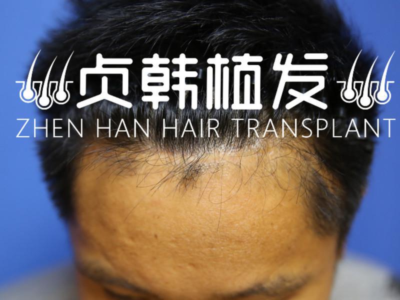 首府南宁疤痕植发一家家地筛选最终确定了贞韩植发