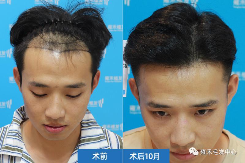 南京雍禾为宗先生植发2610单位解决发际线后退和稀疏