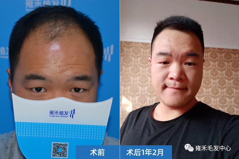 石家庄雍禾为贺先生种植3083单位大额头不见了