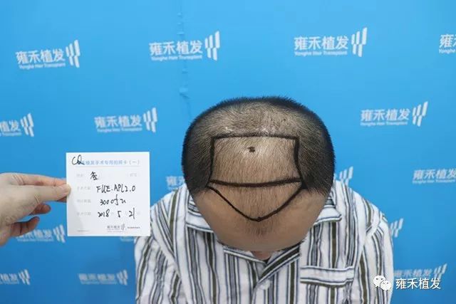 植发手术后4个月头顶新头发越来越多