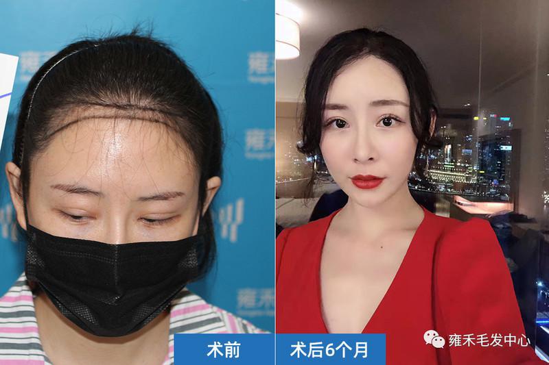 她天生发际高，上海雍禾植发1300单位，美哭了