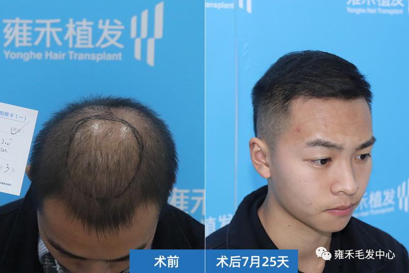 头顶稀仅植发2000单位成都FUE植发效果