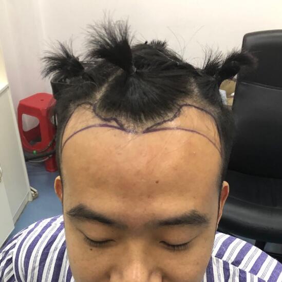 谁说男性不可以做植发，来看看我的植发案例