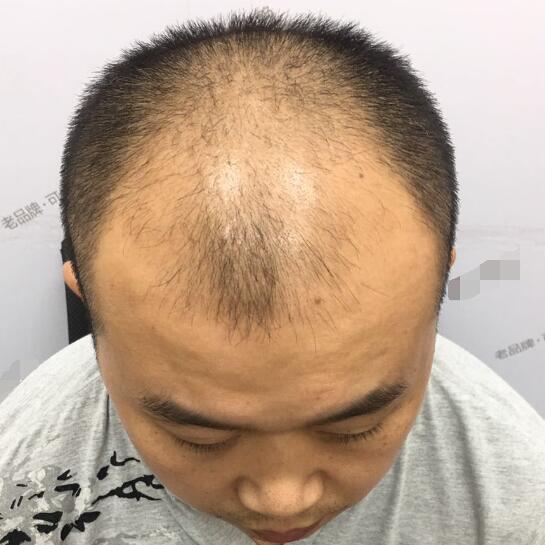 再脱发就没有头发了，只有靠植发拯救自己