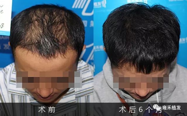 大四艺术生兼职筹钱植发1614单位