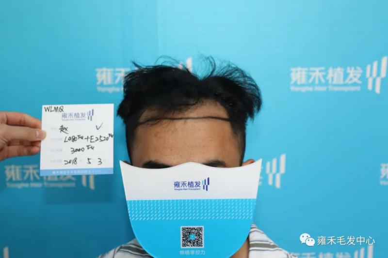 到别的便宜医院植发，还是就在雍禾做植发？
