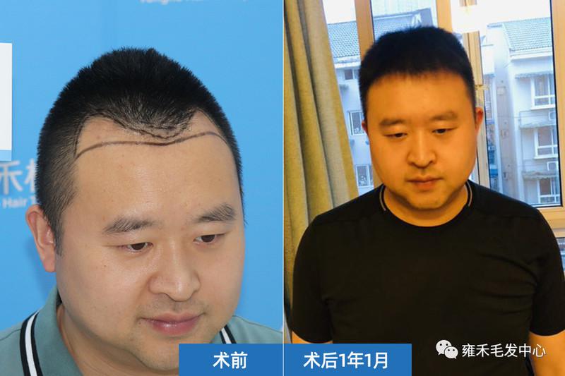 销售脱发植发2100毛囊单位半年形象发际线变好