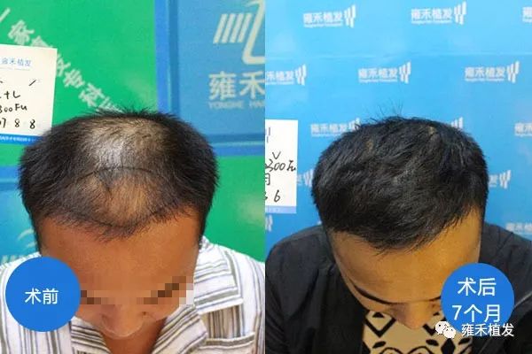 贷款植发！暑期植发！大学生脱发植发2305单位7个月效果图