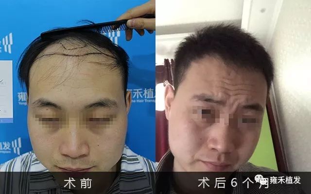 兵哥哥秃了！突袭植发！连夜植发！