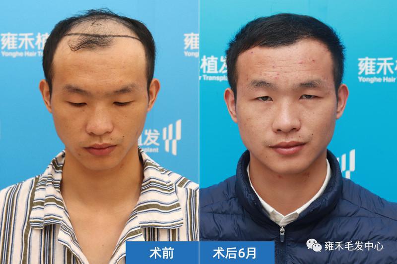 他终于是凑够了植发费用种植3050单位