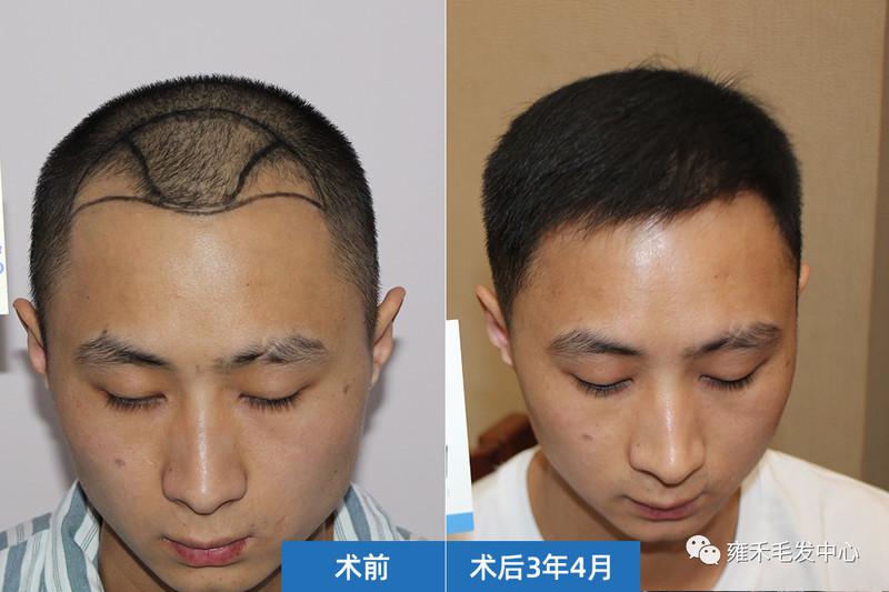因为脱发自卑上海雍禾为小杜种植2460单位