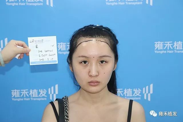 美女考察医院半年才植发，花时间选医院比花钱植发还重要！
