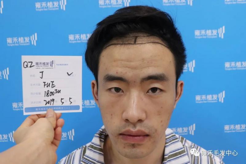 第一次来院咨询，第一次就确定植发，人变得帅气