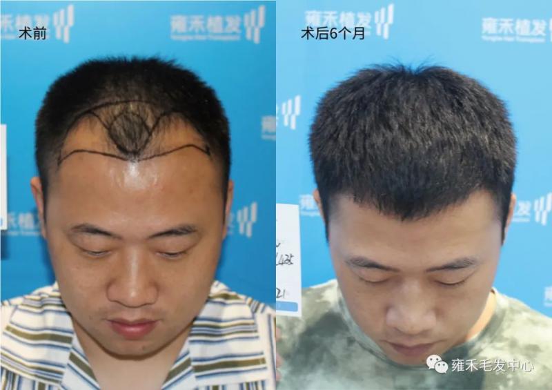 植发半年就又年轻好几岁！植发真是一个杠杆