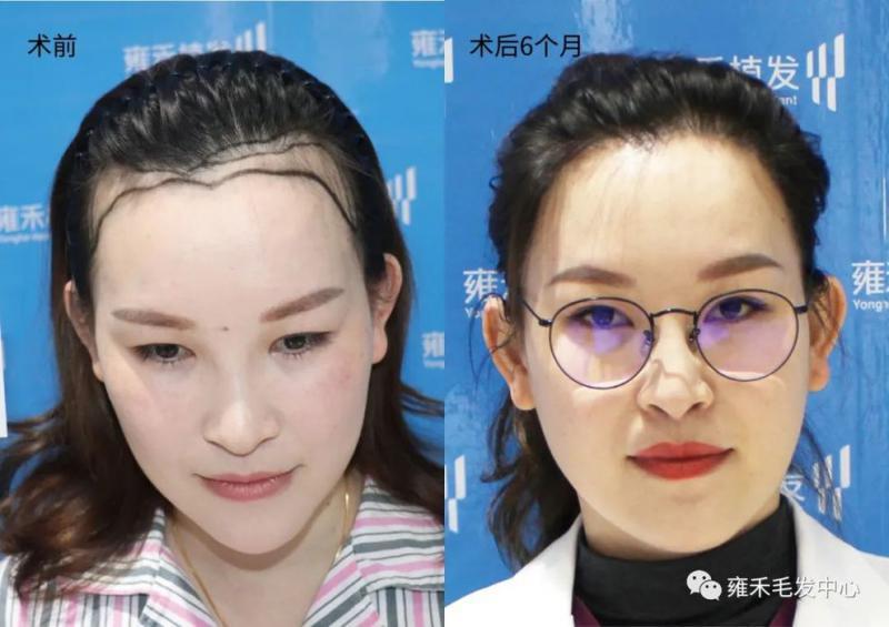 美女植发医生给自己种头发福州植发效果图