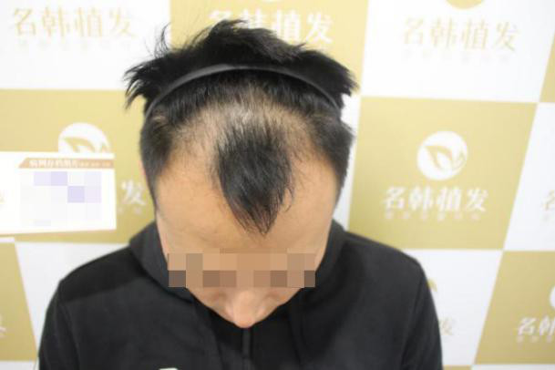 济南武林高手脱发严重植发圣手助其植发成功