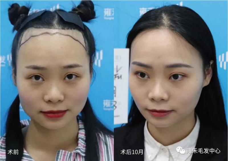 重庆雍禾为陈女士种植发际线2550单位