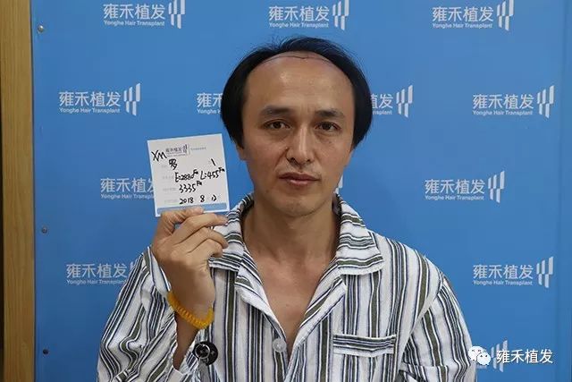 罗先生在厦门筛选植发医院植发种头发年轻好几岁