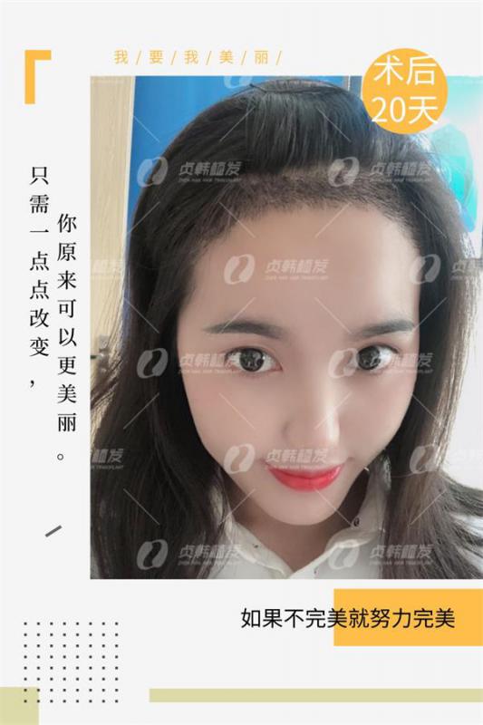 趁午休植个发贞韩导医美眉植发际线变美不耽误工作