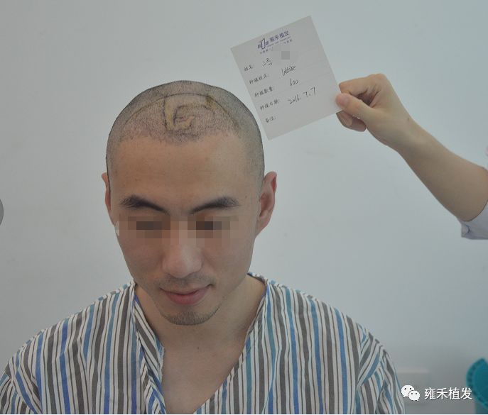 仅820单位！很小面积植发！四两撬起千斤帅！