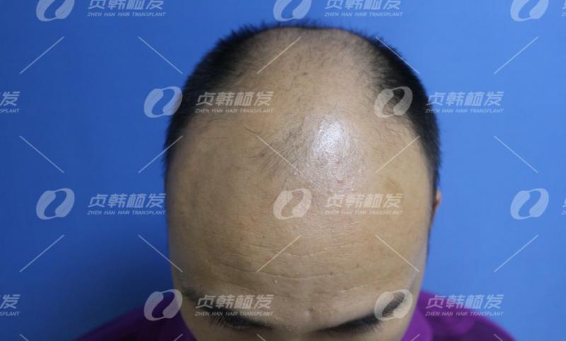 大秃刚30头顶大面积脱发自己抬不起头又低不下头
