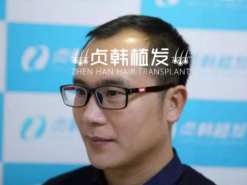 从考察到决定植发要多长时间？南宁老师5次上门才植发