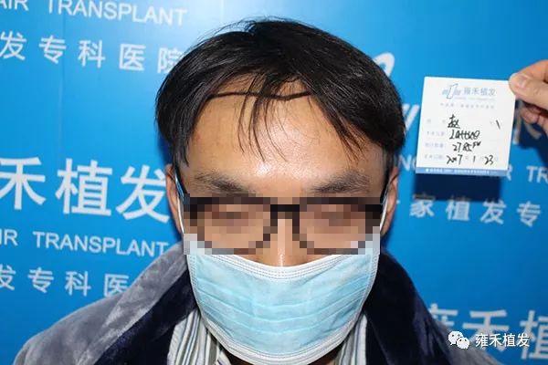 他戴着口罩植发际线3059单位