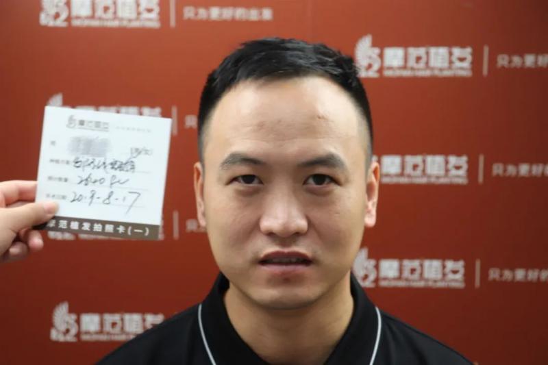 未老头先秃！您的完美发线我的不懈追求！